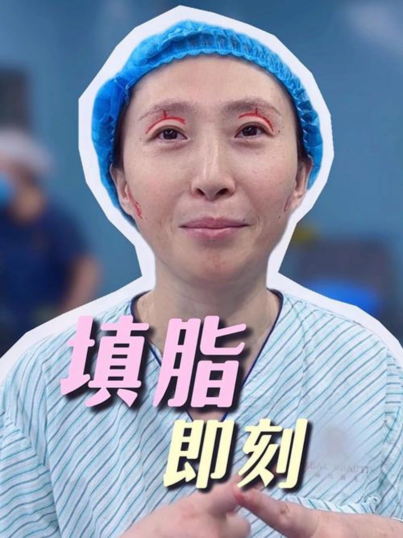 自体脂肪填充