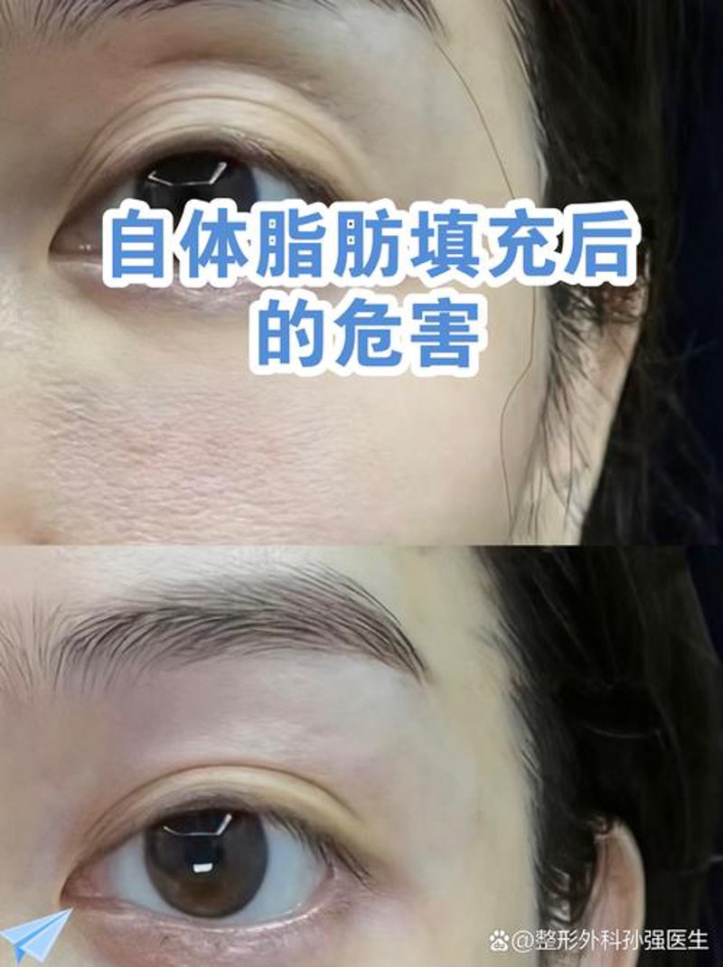 警惕隆鼻手术的常见误区