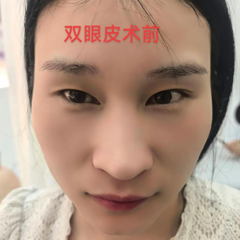 隆鼻手术
